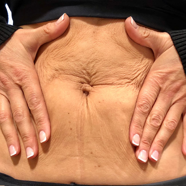 Lipoescultura Eliminar La Grasa Abdominal Sin Cirugia Cirugía